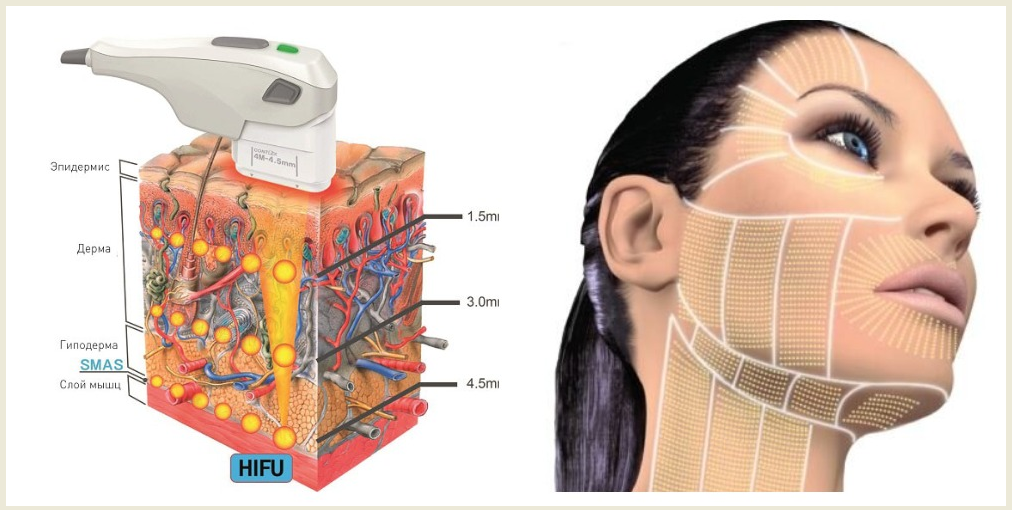 СМАС ліфтинг у салоні краси