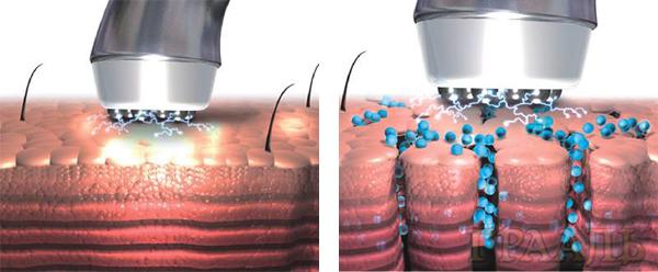 Mesoterapia sin inyecciones en el salón Grail
