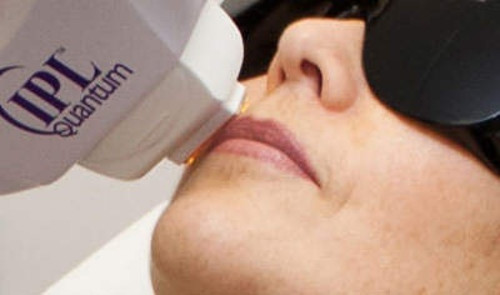Laser hair removal of the upper lip at the Grail salon