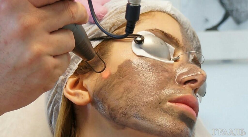 Carbon peeling for face and body