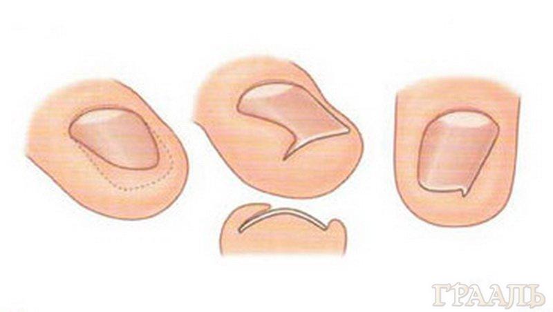 Удаление вросших ногтей в салоне «El grial salon»