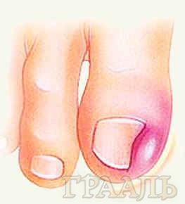 Удаление вросших ногтей в салоне красоты «El grial salon»